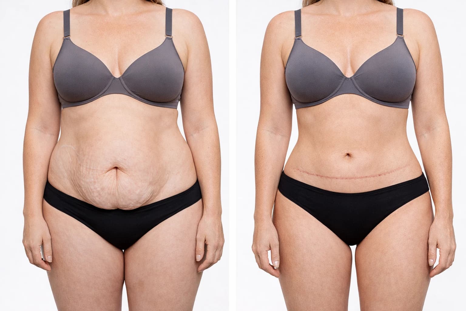 Abdominoplastie + Diastasis — avant / après