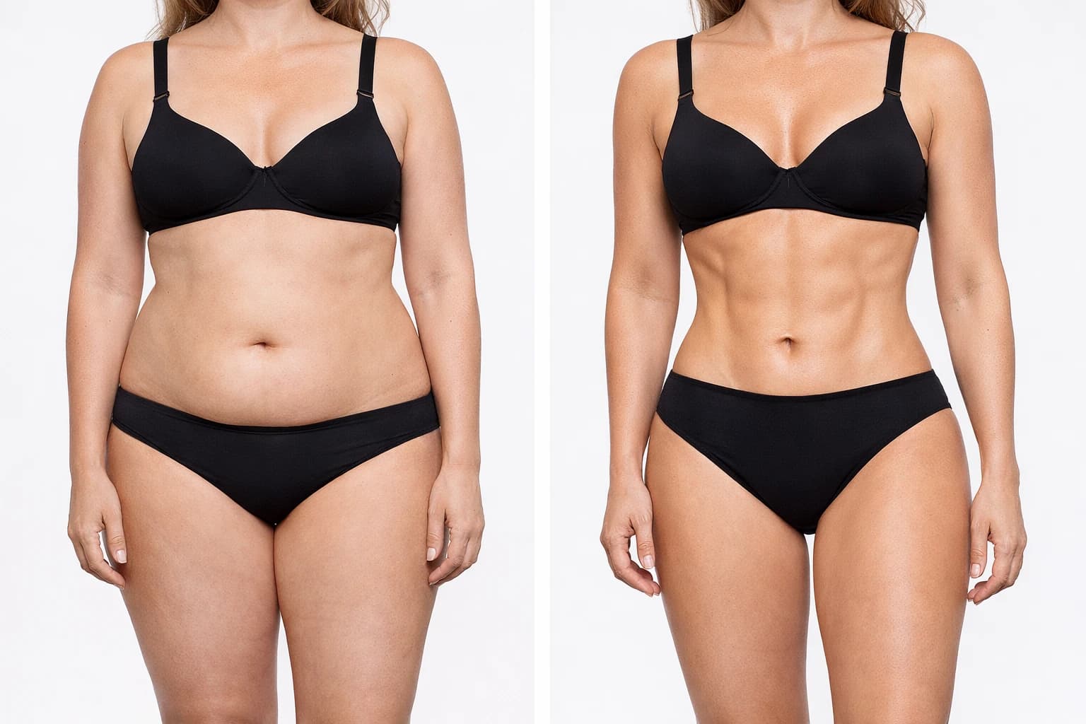 Liposuccion VASER HD 360 — avant / après
