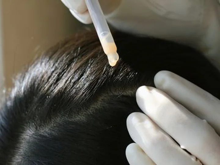 Traitements contre la chute de cheveux