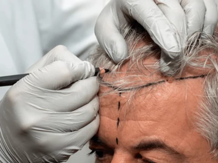 Quel est le meilleur âge pour faire une greffe de cheveux ?