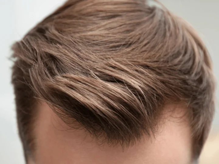 Implants de cheveux : à partir de quel âge peut-on faire une greffe ?