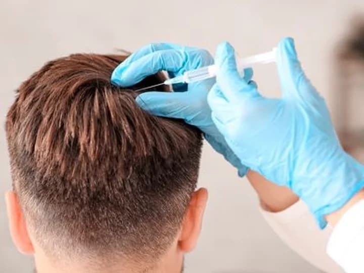 Mésothérapie Capillaire : Stopper la Chute et Renforcer Vos Cheveux